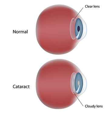 Cataract Portland