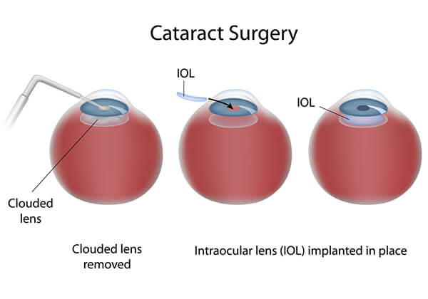 Cataract Surgery Portland