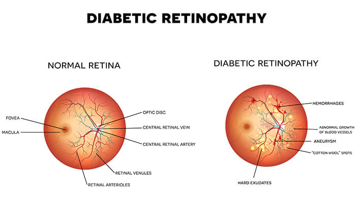 Diabetic Retinopathy Brusnwick