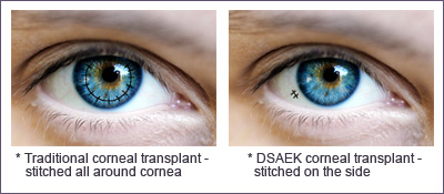 Corneal Transplant Portland